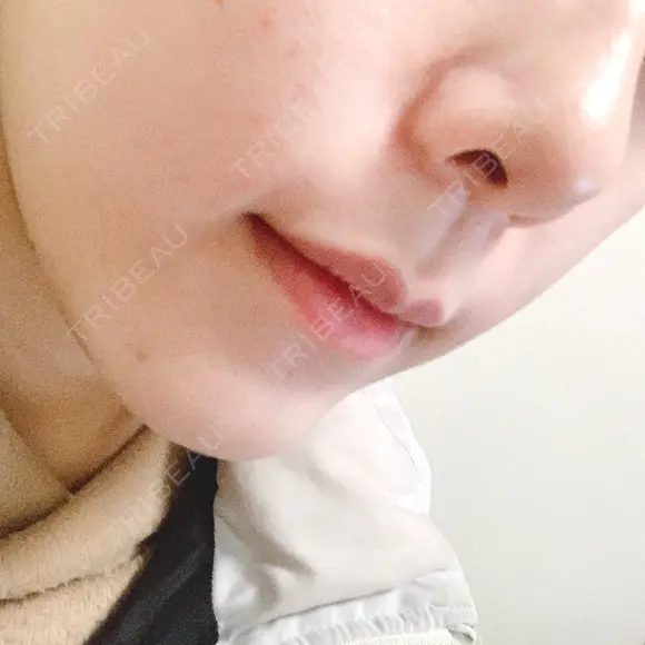 骨切り（あご） / 脂肪吸引（顔） / セットバック / ルフォー+ssro（両あご) リッツ美容外科 東京院 DAY 22 メイン用