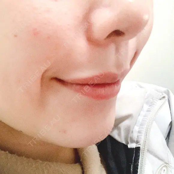 骨切り（あご） / 脂肪吸引（顔） / セットバック / ルフォー+ssro（両あご) リッツ美容外科 東京院 DAY 22 メイン用