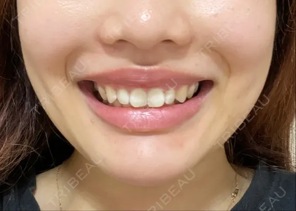 ボトックス（あご） / ボトックス（人中） Tokyo Tensei Clinic 新宿院 DAY 2 メイン用