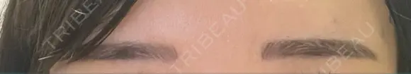 アートメイク（眉） ミケイ医院 DAY 7 メイン用