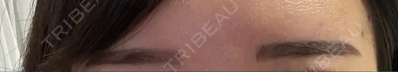 アートメイク（眉） ミケイ医院 DAY 8 メイン用