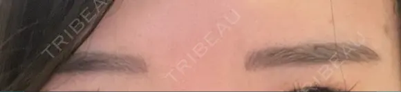 アートメイク（眉） ミケイ医院 DAY 10 メイン用
