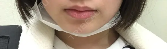 脂肪溶解注射（まぶた） 横浜中央クリニック 横浜院 DAY 0 メイン用