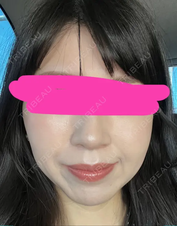 ハイフ（顔） プラチナクリニック DAY 7 メイン用