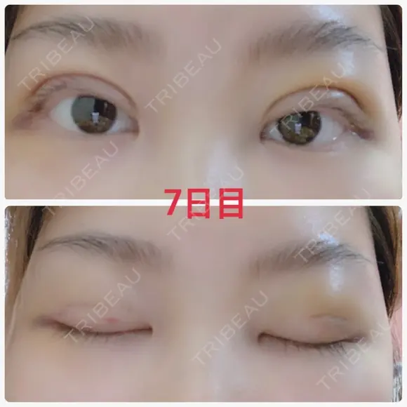 二重埋没 / 上まぶたの脂肪取り 湘南美容クリニック 奈良院 DAY 7 メイン用