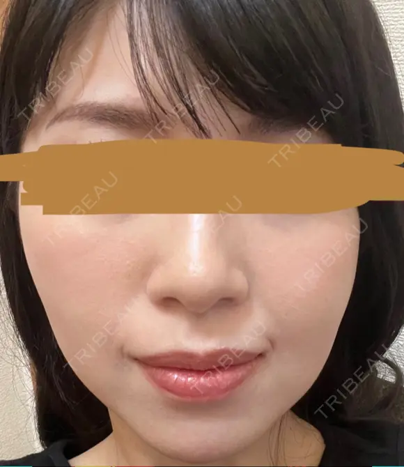 ハイフ（顔） プラチナクリニック DAY 9 メイン用