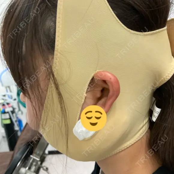糸リフト / 脂肪吸引（顔） BLINC CLINIC （ブリンク クリニック） DAY 0 メイン用