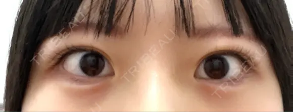 ヒアルロン酸注入（涙袋） フィラークリニック 大阪心斎橋院 DAY 0 メイン用