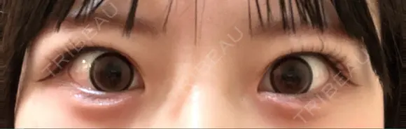 ヒアルロン酸注入（涙袋） フィラークリニック 大阪心斎橋院 AFTER メイン用