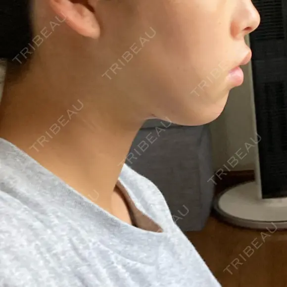 糸リフト / 脂肪吸引（顔） BLINC CLINIC （ブリンク クリニック） DAY 2 メイン用
