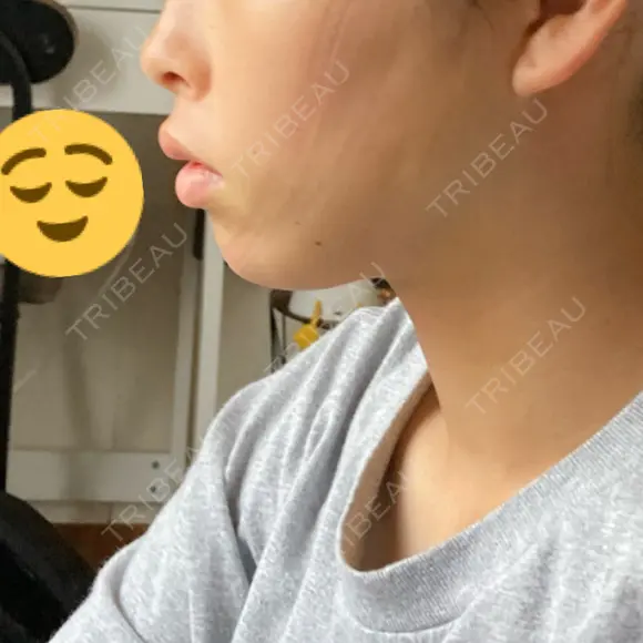 糸リフト / 脂肪吸引（顔） BLINC CLINIC （ブリンク クリニック） DAY 2 メイン用