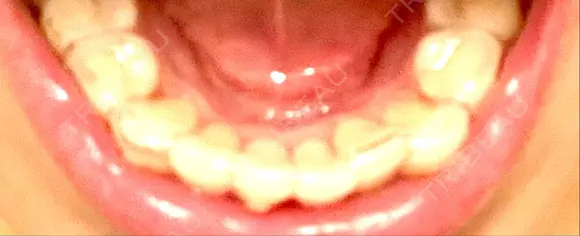 矯正（マウスピース） 目黒まついデンタルクリニック DAY 120 メイン用