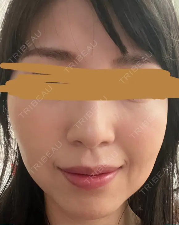 ハイフ（顔） プラチナクリニック DAY 13 メイン用