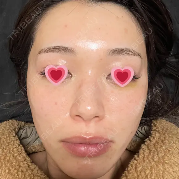 LED治療 The Natural Beauty Clinic 恵比寿院 DAY 5 メイン用