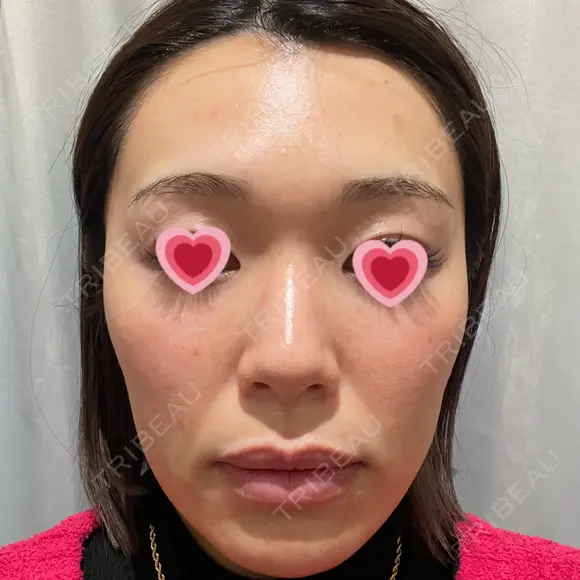 LED治療 The Natural Beauty Clinic 恵比寿院 DAY 7 メイン用