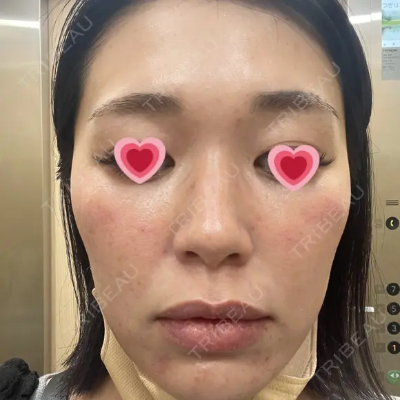 LED治療 The Natural Beauty Clinic 恵比寿院 AFTER メイン用