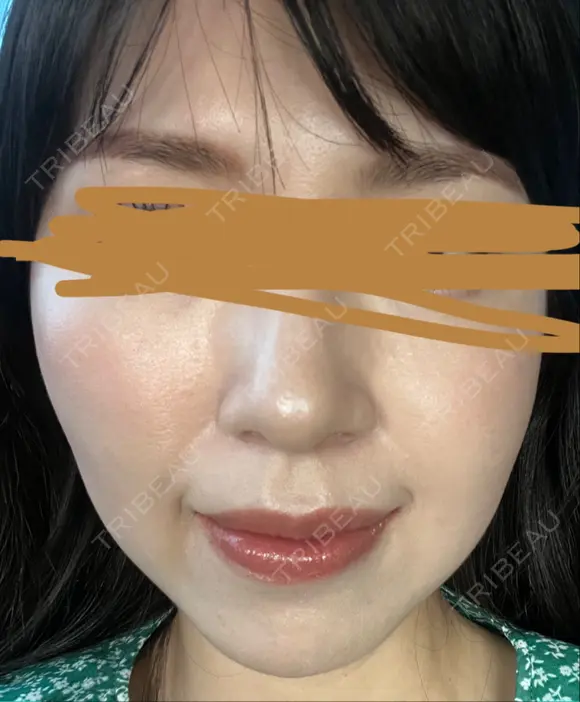 ハイフ（顔） プラチナクリニック DAY 14 メイン用