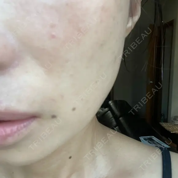 その他（肌） / ピーリング（ニキビ・毛穴） / ピーリング（ハリ・ツヤ） AURORA CLINIC（オーロラクリニック）新宿院 AFTER メイン用