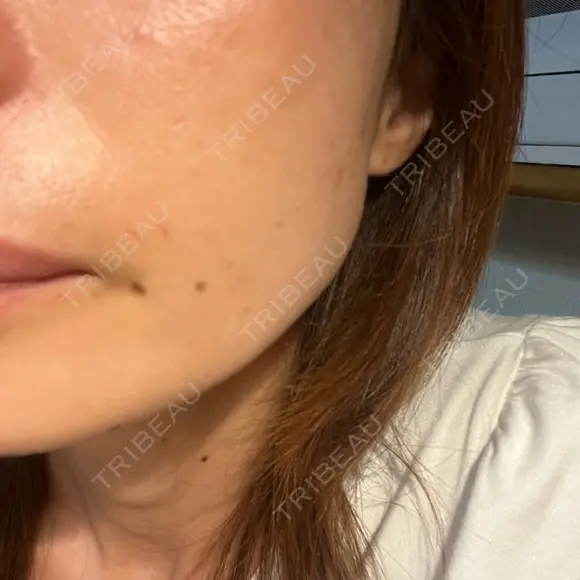 その他（肌） / ピーリング（ニキビ・毛穴） / ピーリング（ハリ・ツヤ） AURORA CLINIC（オーロラクリニック）新宿院 DAY 1 メイン用