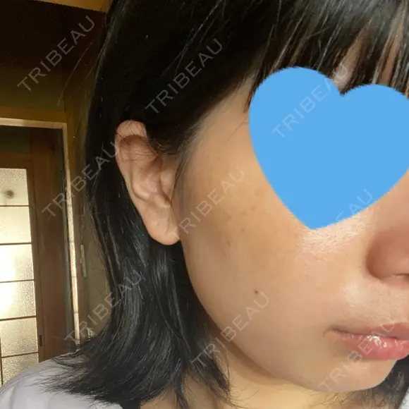 光治療（フォトフェイシャルなど） まゆりなclinic 名古屋栄 DAY 2 メイン用