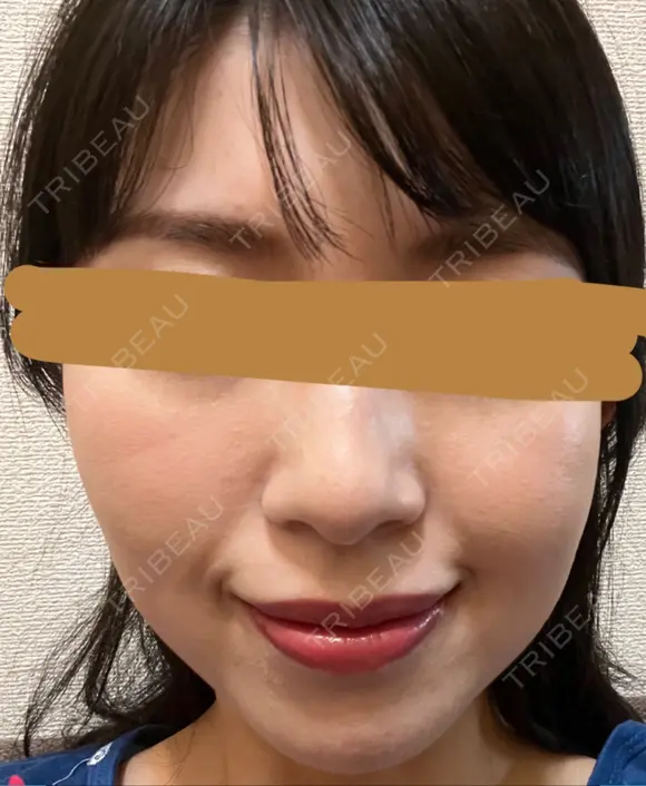 ハイフ（顔） プラチナクリニック AFTER メイン用