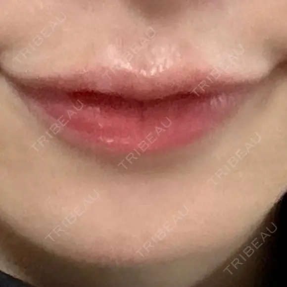 ヒアルロン酸注入（唇） あじまビューティークリニック AFTER メイン用