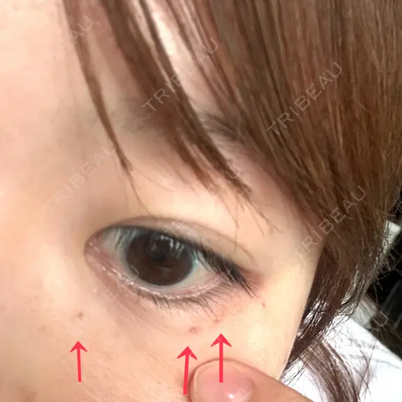 ピコスポット Fellez Clinic【フェルズクリニック】 DAY 1 メイン用