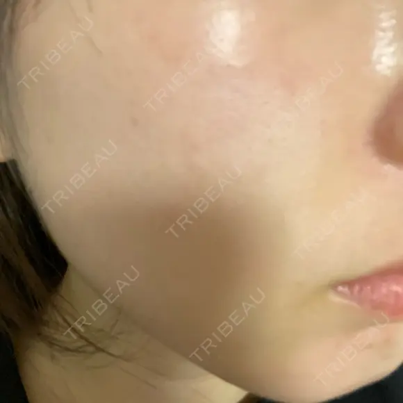 ダーマペン 美容皮膚科しらゆきクリニック DAY 1 メイン用