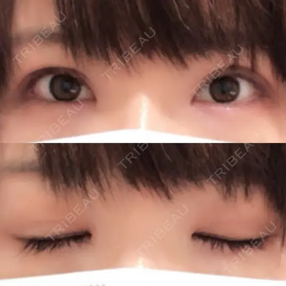 二重切開 / 目元修正 ルネッサンス美容外科医院 神戸院 DAY 62 メイン用