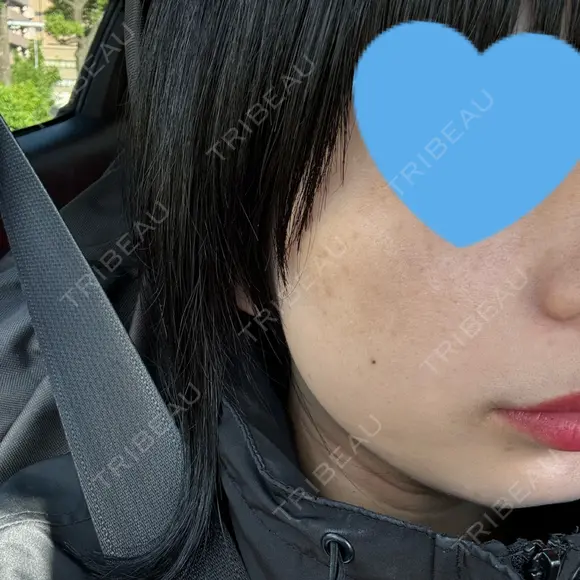 光治療（フォトフェイシャルなど） まゆりなclinic 名古屋栄 DAY 4 メイン用