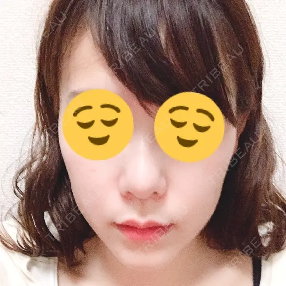 骨切り（あご） / 脂肪吸引（顔） / セットバック / ルフォー+ssro（両あご) リッツ美容外科 東京院 DAY 23 メイン用