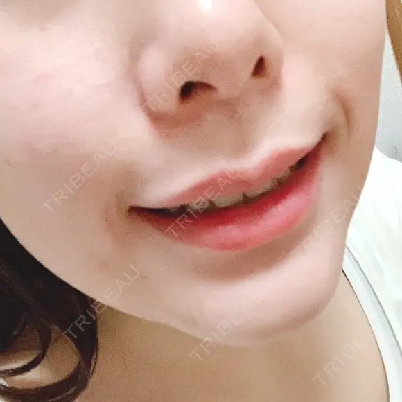 骨切り（あご） / 脂肪吸引（顔） / セットバック / ルフォー+ssro（両あご) リッツ美容外科 東京院 DAY 23 メイン用