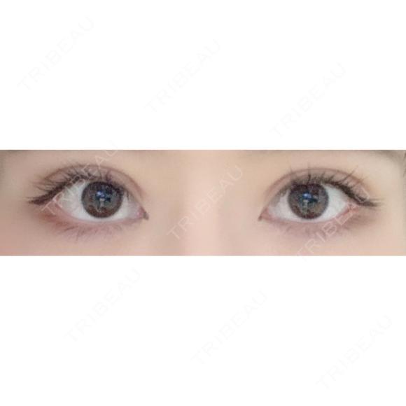 二重切開 / 眼瞼下垂（切開） / その他（目元） / 上まぶたたるみ取り / 上まぶたの脂肪取り / 目元修正 リビジョンクリニック（旧：池本形成外科・美容外科） AFTER メイン用