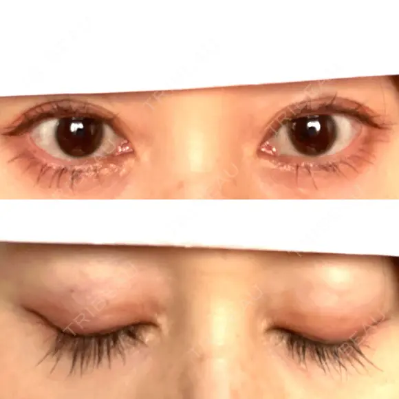 二重埋没 / 糸リフト / 下まぶたの脂肪取り / 目元修正 / 肌ヒアルロン酸注入（たるみ・シワ改善） ネビュラクリニック 広島院 AFTER メイン用