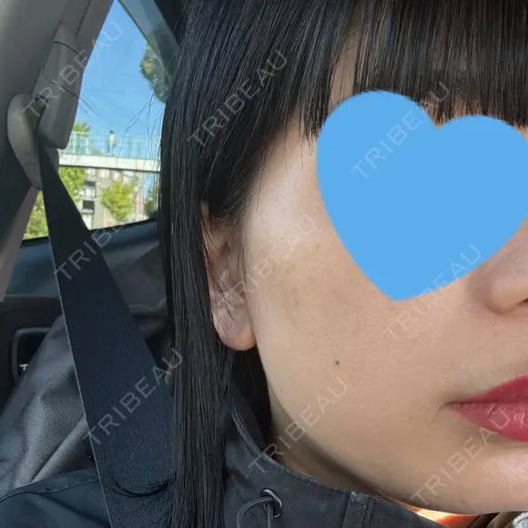 光治療（フォトフェイシャルなど） まゆりなclinic 名古屋栄 DAY 7 メイン用