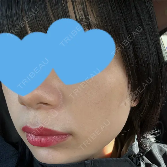 光治療（フォトフェイシャルなど） まゆりなclinic 名古屋栄 DAY 7 メイン用