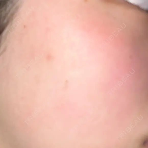 ピーリング（ニキビ・毛穴） LIFIX BEAUTY CLINIC AFTER メイン用