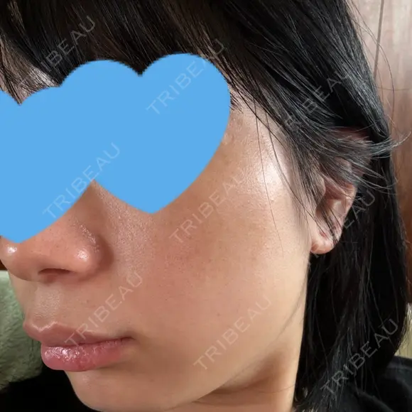 光治療（フォトフェイシャルなど） まゆりなclinic 名古屋栄 DAY 8 メイン用