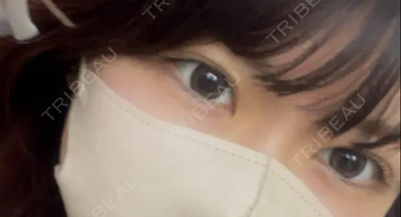 二重埋没 湘南美容クリニック 仙台院 DAY 215 メイン用