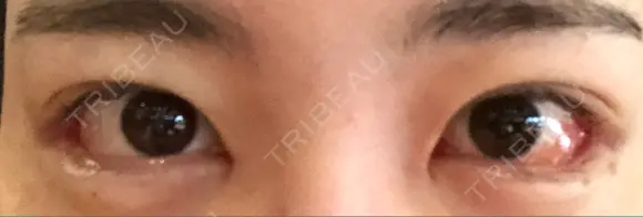 目頭切開 / 目尻切開 / タレ目形成・グラマラスライン（切開） EMMA CLINIC（エマクリニック） DAY 7 メイン用