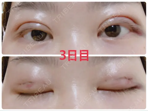 二重埋没 / 上まぶたの脂肪取り 湘南美容クリニック 奈良院 DAY 3 メイン用