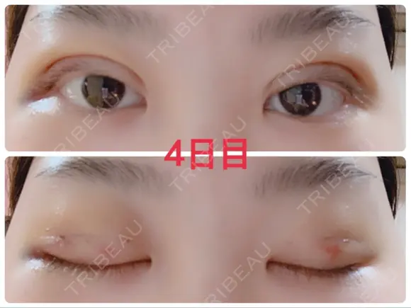 二重埋没 / 上まぶたの脂肪取り 湘南美容クリニック 奈良院 DAY 4 メイン用