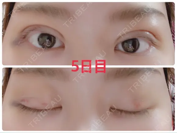 二重埋没 / 上まぶたの脂肪取り 湘南美容クリニック 奈良院 DAY 5 メイン用