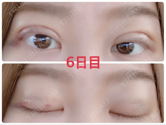 二重埋没 / 上まぶたの脂肪取り 湘南美容クリニック 奈良院 DAY 6 メイン用