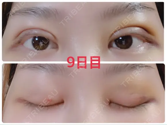 二重埋没 / 上まぶたの脂肪取り 湘南美容クリニック 奈良院 DAY 9 メイン用