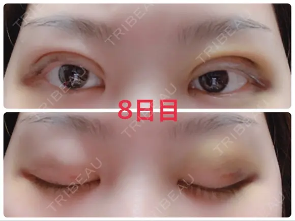 二重埋没 / 上まぶたの脂肪取り 湘南美容クリニック 奈良院 DAY 8 メイン用