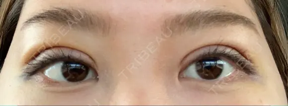 二重埋没 / 上まぶたの脂肪取り 湘南美容クリニック 奈良院 DAY 8 メイン用