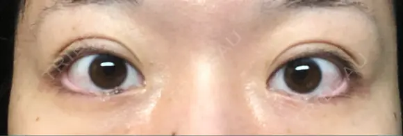 二重埋没 TCB東京中央美容外科 青森院 DAY 61 メイン用