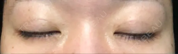 二重埋没 TCB東京中央美容外科 青森院 DAY 61 メイン用