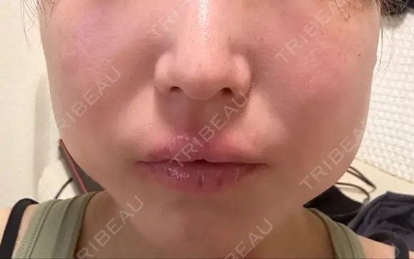 ボトックス（エラ・小顔） 湘南美容クリニック 岐阜院 DAY 1 メイン用